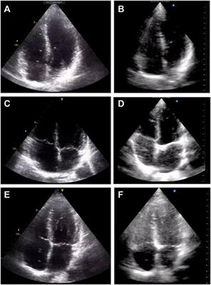 Comparison of Newer Hand-Held Ultrasound Devices for Post-Dive Venous gas Emboli Quantification to Standard Echocardiography